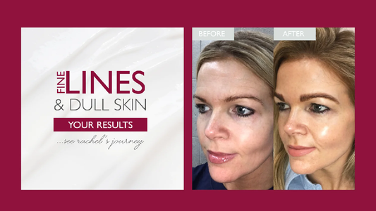 Rachel's Skin Journey: Dull / Ageing skin