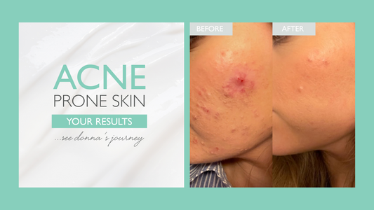 Donna's Skin Journey: How To Treat Acne with SKINICIAN