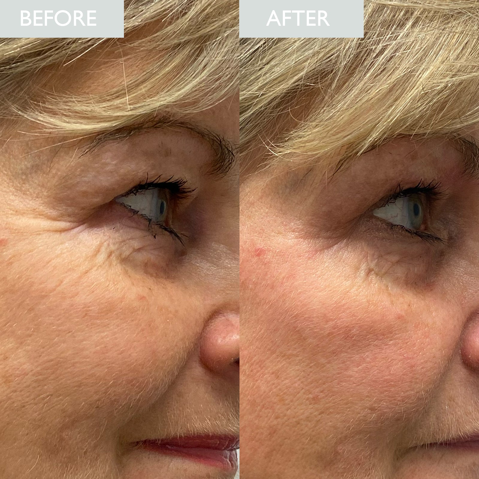 A before and after of a lady who had used skinician hyaluronic acid, showing reduced fine lines and wrinkles