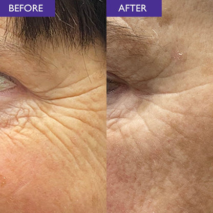 A before and after image showing a reduction in lines around the eye area with Skinician powerbalm level 1