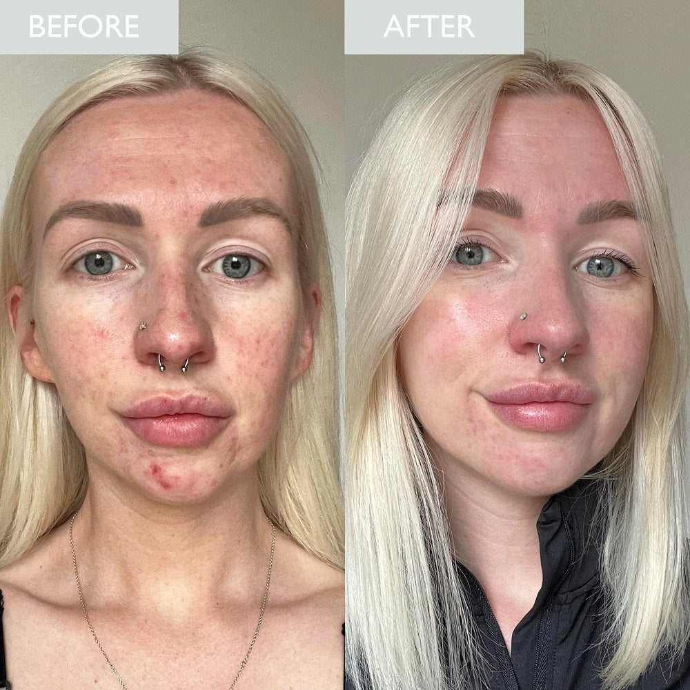 Before and after image of a women, showing improvement in breakouts after using skinician products